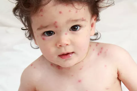 decociunea de la varicoza tratamentul venelor varicose leaches recenzii