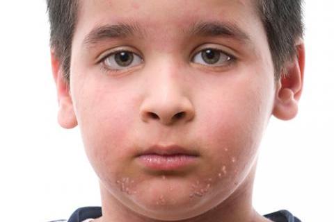 Molusco contagioso en la piel de un niño
