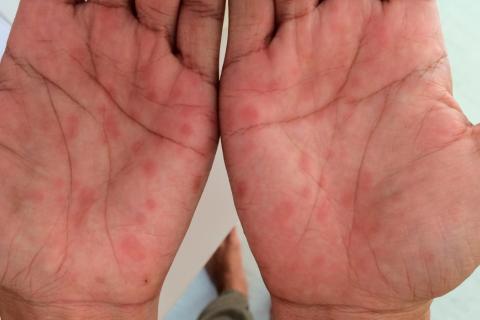 Sífilis secundaria en la palma de las manos