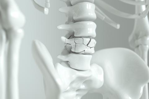 Osteoporosis en la columna