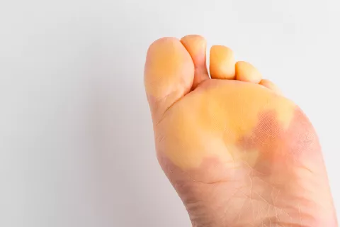 Fenómeno de Raynaud en el pie