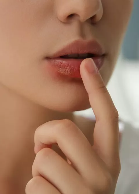 Mujer con un herpes en la boca y un gesto de duda con el dedo