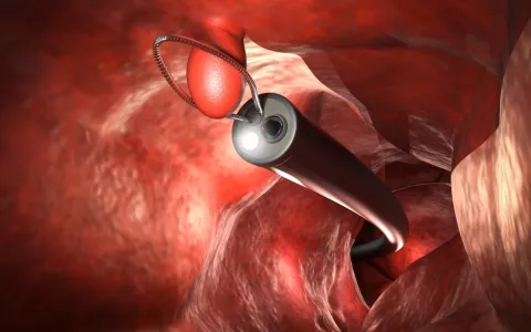 Endoscopio en 3D introducido rectalmente para intervernir