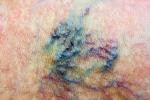 Complicaciones de varices en la piel