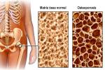 Ilustración de la densidad ósea en la osteoporosis