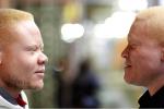 Signos y síntomas del albinismo
