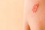 Síntomas del herpes zóster en la piel
