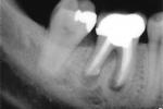 Procedimientos asociados a la endodoncia 