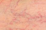 Síntomas de varices en la piel