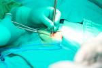 Cirugía para tratar la hernia inguinal