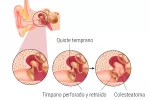 Causas del colesteatoma y tipos Causas del colesteatoma y tipos