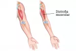Causas de la distrofia muscular de Duchenne Causas de la contracción muscular en la distrofia muscular de Duchenne