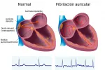 Causas y factores de riesgo de la fibrilación auricular Factores de riesgo de la fibrilación auricular