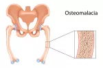 Causas de la osteomalacia Causas de la osteomalacia