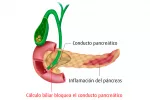 Causas de pancreatitis Ilustración de las causas de pancreatitis