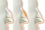 Cómo se realiza una rinoplastia