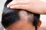 Cuándo se hace un tricograma capilar Hombre con pérdida de cabello en una zona de la cabeza