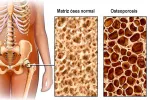Tipos de osteoporosis Ilustración de la densidad ósea en la osteoporosis