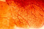 Diagnóstico de la distrofia muscular de Duchenne Diagnóstico de la distrofia muscular de Duchenne