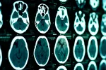 Diagnóstico de parálisis cerebral Diagnóstico de parálisis cerebral