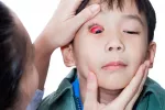 Diagnóstico del tracoma Diagnóstico del tracoma