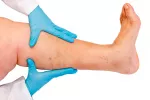 Diagnóstico de varices Diagnóstico de varices en consulta