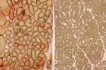 Estadificación y clasificación pronóstica del cáncer de testículo Estadificación del cáncer de testículo