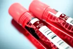 Diagnóstico de la infección por Hantavirus Análisis de sangre
