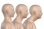 Pronóstico de la escoliosis Ángulo de la curva escoliótica