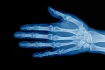 Diagnóstico de la pubertad precoz Radiografía de la muñeca en adolescente
