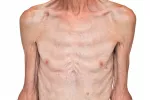 Síntomas y tipos de desnutrición Síntomas de desnutrición
