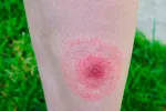 Eritema migrans: síntoma de la enfermedad de Lyme Síntomas de la enfermedad de Lyme