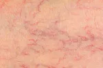 Síntomas de varices en la piel