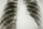 Tipos de cáncer de pulmón Rayos X del pulmón