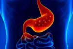 Gastritis crónica Tipo de gastritis crónica