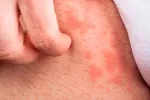 Tipos de urticaria Tipos de urticaria en la piel