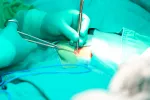 Tratamiento de la hernia inguinal Cirugía para tratar la hernia inguinal