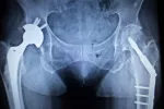 Tratamiento de la osteonecrosis Cómo tratar la osteonecrosis