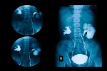 Cómo se hace la urografía Radiografía de los riñones