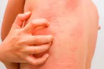 Urticaria acuagénica, la extraña alergia al agua Urticaria acuagénica, alergia al agua