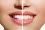 Dientes manchados por alimentos Qué alimentos manchan tus dientes