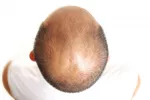 Alopecia areata Caballero con alopecia areata