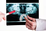 Asocian bruxismo y fallo de los implantes dentales Un dentista sujeta una férula de descarga frente a una radiografía