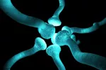 Neurotransmisores Causas de la fibromialgia