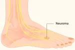 Origen y causas del neuroma de Morton