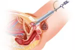 Cistoscopia Ilustración del procedimiento de una cistoscopia