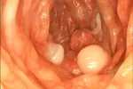 Procedimiento de una colonoscopia Cómo se hace una colonoscopia