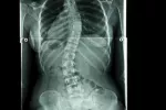 Radiografía diagnóstica de escoliosis Diagnóstico de la escoliosis