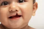 Identifican un gen asociado con el labio leporino Niño con labio leporino