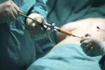 Liposucción La liposucción, la mejor técnica para eliminar grasa